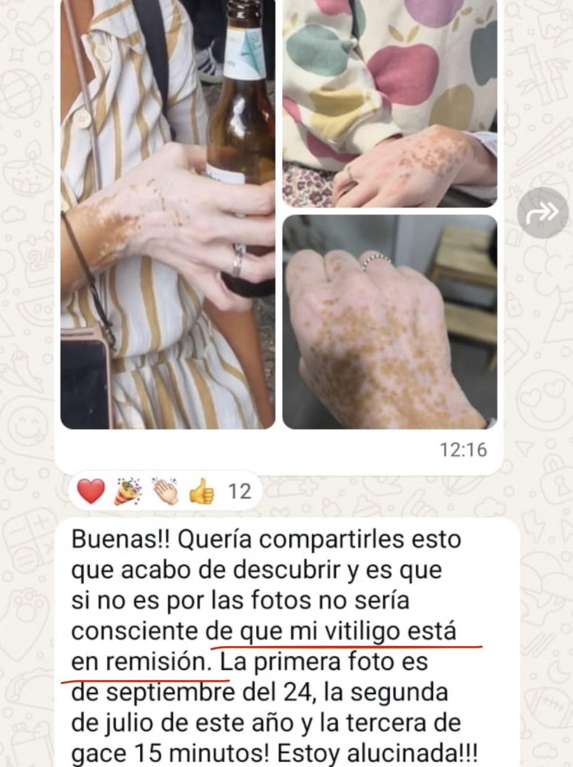Testimonio real de alumna, vitíligo en remisión, fotos comparativas