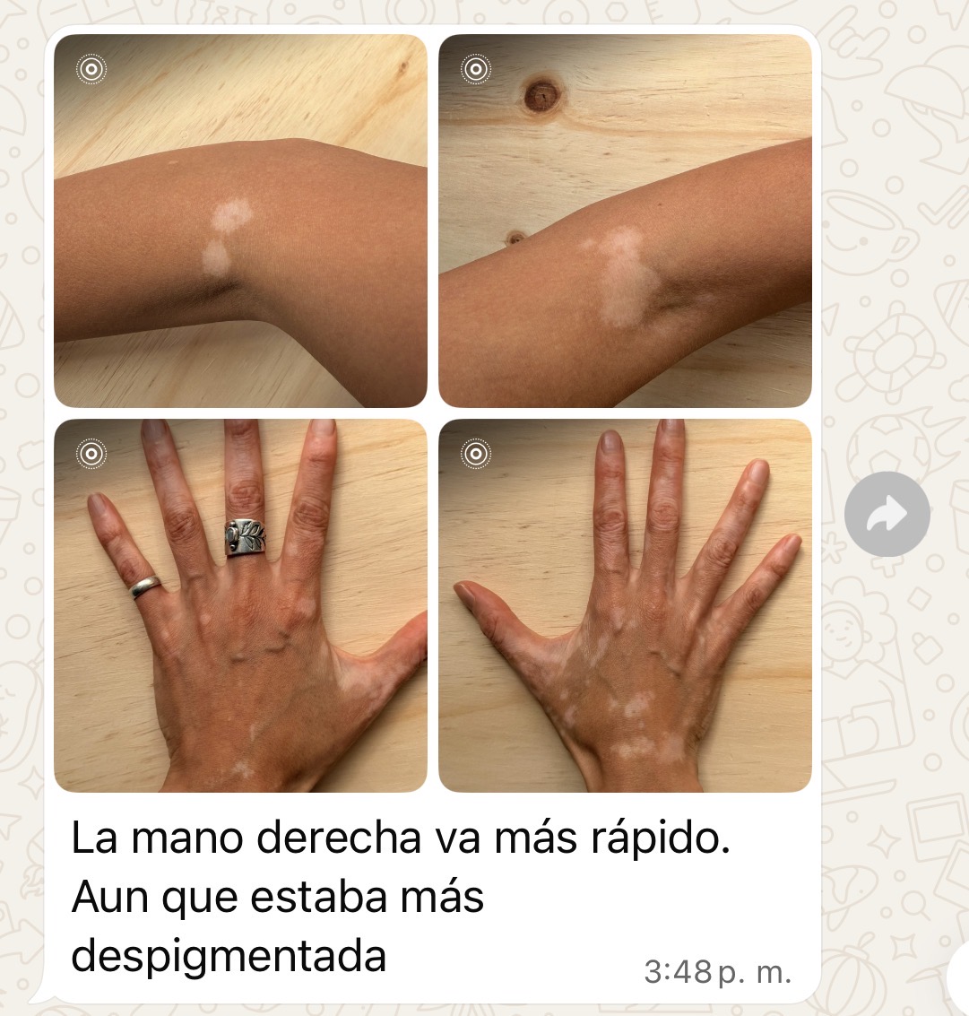 Testimonio real de alumna, avance de vitíligo